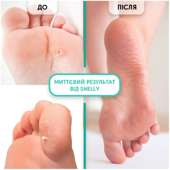 Гель-кератолитик для локального применения Shelly Мягкое лезвие 100 мл2